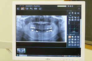 デジタルレントゲン画像